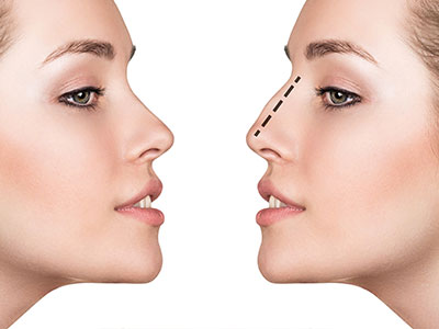 Rhinoplastie