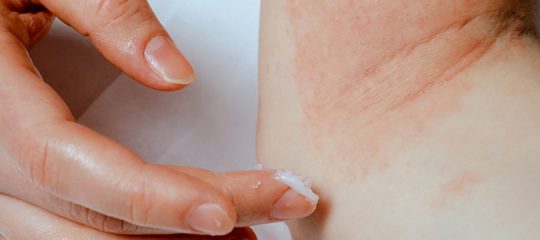 psoriasis en goutte