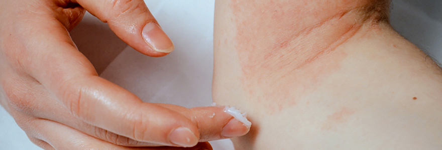 psoriasis en goutte